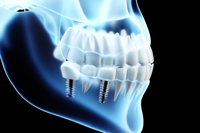 インプラントCT画像イメージ